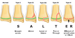<p>define a salter harris type III fracture</p>