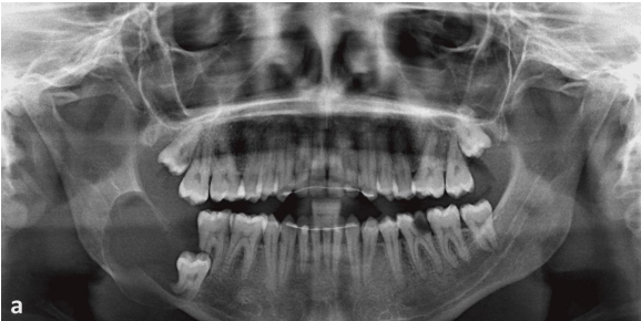 <p>A 25 year old patient present with mild swelling of lower jaw. Intra orally a small swelling was visible over right third molar region. A radiograph taken. Provide Differential diagnosis</p>