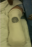 <p>5-7 days (or sooner: severe pain/pressure, significant loosening, or fever and oder present) </p>