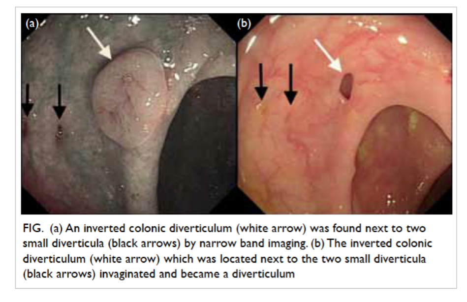 <ul><li><p><span style="background-color: transparent;">Innie versus outie</span></p></li><li><p><span style="background-color: transparent;">Diverticula = pouch</span></p></li><li><p><span style="background-color: transparent;">Colonic polyps = growth</span></p></li></ul><p></p>