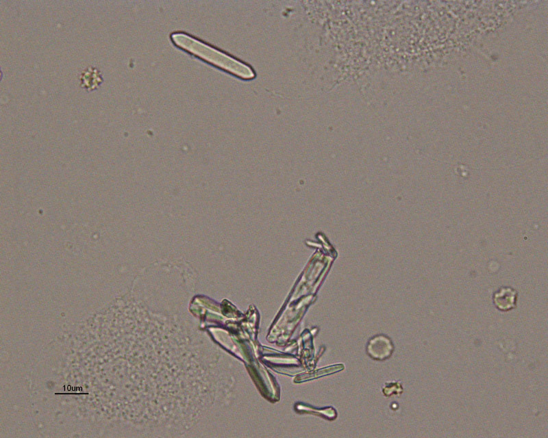 <p>Calcium oxalate crystals (urinalysis)</p>
