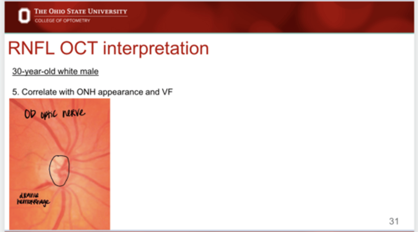 <p>Example: Correlate this nerve ONH appearance with a VF (See Pic)</p>