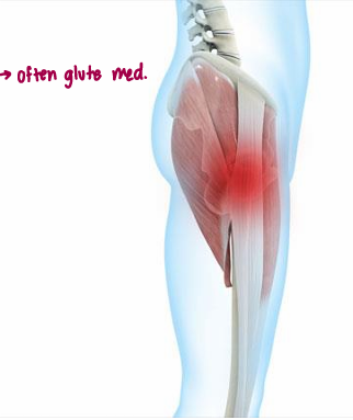 <p><span style="color: red;"><strong>gluteal tendinopathy </strong></span>→ usually gluteus medius</p>