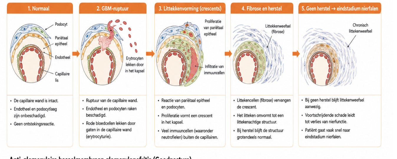 <ul><li><p>ruptuur van capi wand → endotheel en podocytenlaag raken beschadigd </p></li><li><p>dan is er een reactie van parietaal epitheel en podocuten → crescent ontstaat </p></li><li><p>dan zijn er 2 opties</p><ul><li><p>littekenvorming = cresecent </p></li><li><p>herstel → alleen als ontstekingsproces geremd wordt, geen herstel = snel eindstadium nierfalen</p></li></ul></li></ul><p></p>
