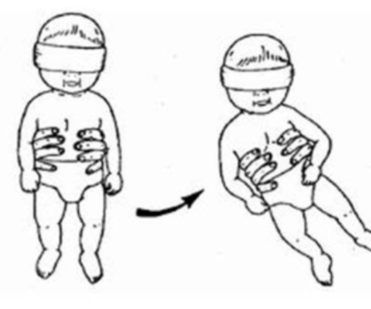<ul><li><p>righting reaction - midbrain/red nucleus</p></li><li><p>onset: birth - 2 months and then persists throughout life</p></li><li><p>drives child to lift head from prone or supine, babies eyes need to be covered to ensure they are not leading with sight (this part is not shown in the photo)</p></li></ul><p></p>