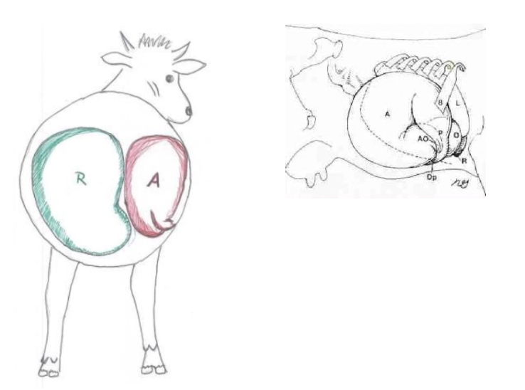 <p><u>Mechanism:</u></p><ol><li><p>Rumen acts as barrier to prevent LDA, but anatomical, mechanical and metabolic factors cause gas distension and atony of the abomasum</p></li><li><p>Allows abomasum to float up on the right side</p></li><li><p>Torsion = Dorsal displacement of the greater curvature</p></li><li><p>→ Counterclockwise (180 - 360˚) torsion as the pylorus moves cranially via the abdominal wall side (2nd flip)</p></li><li><p>→ Complete inflow AND outflow obstruction</p></li><li><p><mark data-color="yellow" style="background-color: yellow; color: inherit;">Vagus nerve compromised within twist</mark></p></li></ol><p><u>Clinical Signs:</u> More acute and serious than LDA</p><ol><li><p>Severe dehydration</p></li><li><p>± Diarrhoea</p></li><li><p>more fluid sounds than LDA</p></li><li><p>Severe illness when torsion develops (shock)</p></li></ol><p>→ Emergency surgery required ASAP</p>