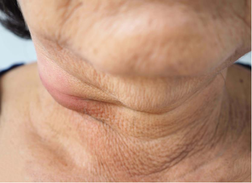 <p>CASE: A 48-year-old patient with little smoking or drinking history presents with an asymptomatic enlarged cervical lymph node and mild dysphagia. Examination identifies a lesion in the tonsillar/base-of-tongue region. Which cancer subtype should be strongly considered?</p>
