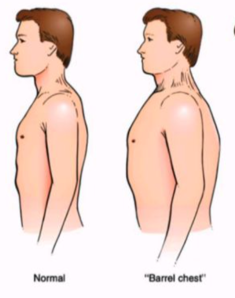 <p>C high headrest</p><div data-type="horizontalRule"><hr></div><p></p><p>A large patient with a large chest needs a high, thick headrest in order for the forehead and chin to be horizontal (neutral position).</p><p>FYI: COPD causes barrel chest <br></p>