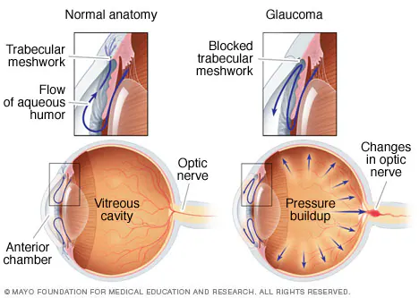 <p><span style="background-color: transparent; font-family: "EB Garamond", serif;">Increased fluid pressure within the eyeball, which damages the optic nerve, leading to vision loss or blindness</span></p>