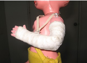 <p>fracture<span> </span>of<span> </span>the<span> </span>shaft<span> </span>of<span> the HUMERUS</span></p>