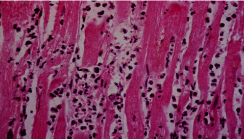 <p>What has happened to this heart tissue?</p>