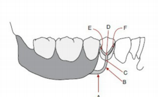 <p>Type of infrabulge Shown</p>