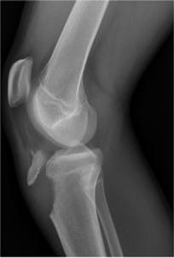 <p>Occurs when a fragment of bone tears away from the main mass of bone as a result of physical trauma</p>