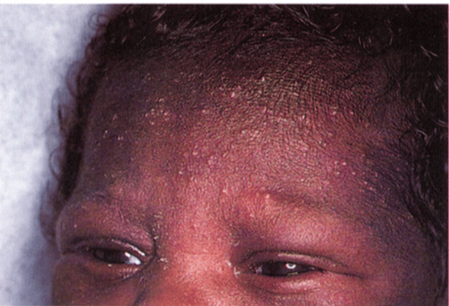 <p>-superficial pustules overlying darker macules, usually in dark skinned babies</p>