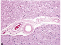 <p>How does hypertension lead to lacunar infarcts pathologically?</p>
