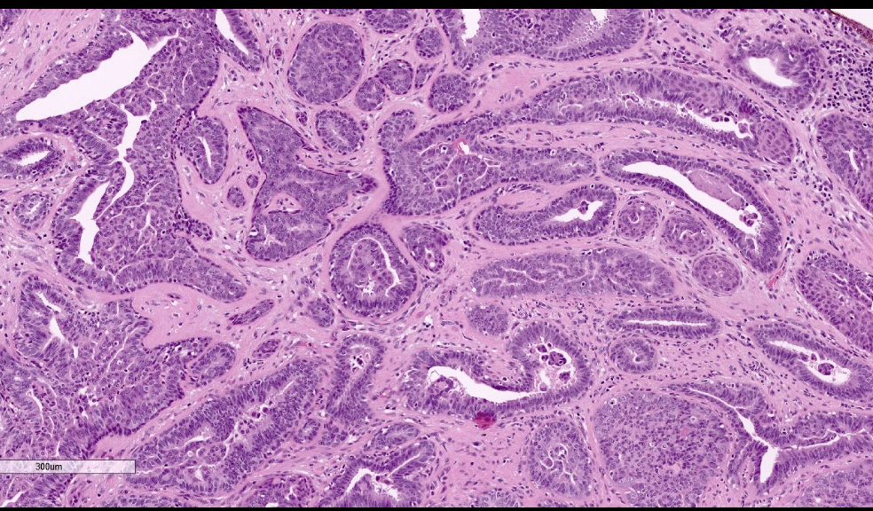 <p>Tumeur du mamelon</p><p>1) diagnostic </p><p>2) morphologie</p>