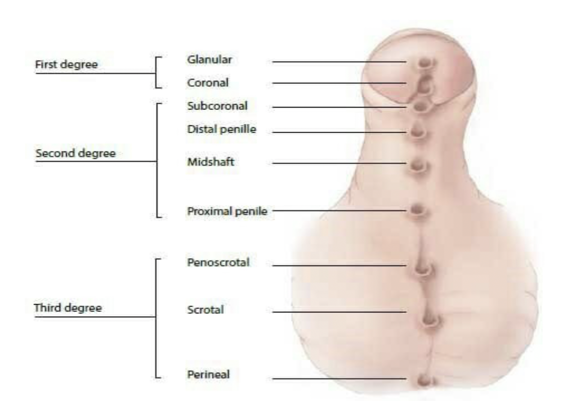 <ul><li><p>Hypospadias (refer to image)</p><ul><li><p>penile birth defect - where the hole is at the bottom instead of the tip</p></li></ul></li></ul><p></p><ul><li><p>Neural tube defects </p><ul><li><p>brain, spinal cord, spine</p></li></ul></li></ul><p></p><ul><li><p>Cleft lip or cleft palate</p><ul><li><p>top lip doesnāt join together / palate has a slight cleft, or is not fully joined together</p></li></ul></li></ul><p></p>