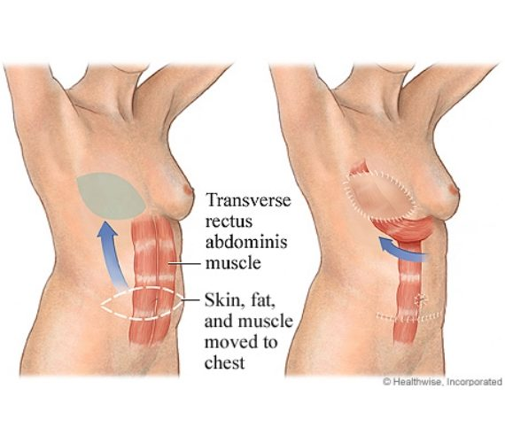 <p>Transverse Rectus Abdominis Myocutaneous flap</p>