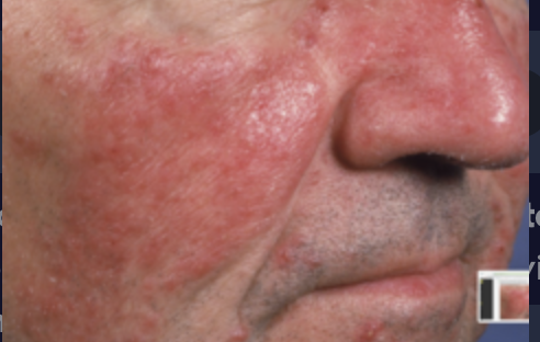 <p>Paciente masculino de 57 años de edad, diabético, sin embargo refiere estar bien controlado. Acude por una dermatosis de varios años de evolución, que empeora con la exposición solar, consumo de alcohol y comidas muy picantes. Es asintomática, pero ha notado que ha empeorado con el paso de los años. Niega aplicaciones tópicas de medicamentos o remedios caseros. ¿Cuál sería su tratamiento?</p>