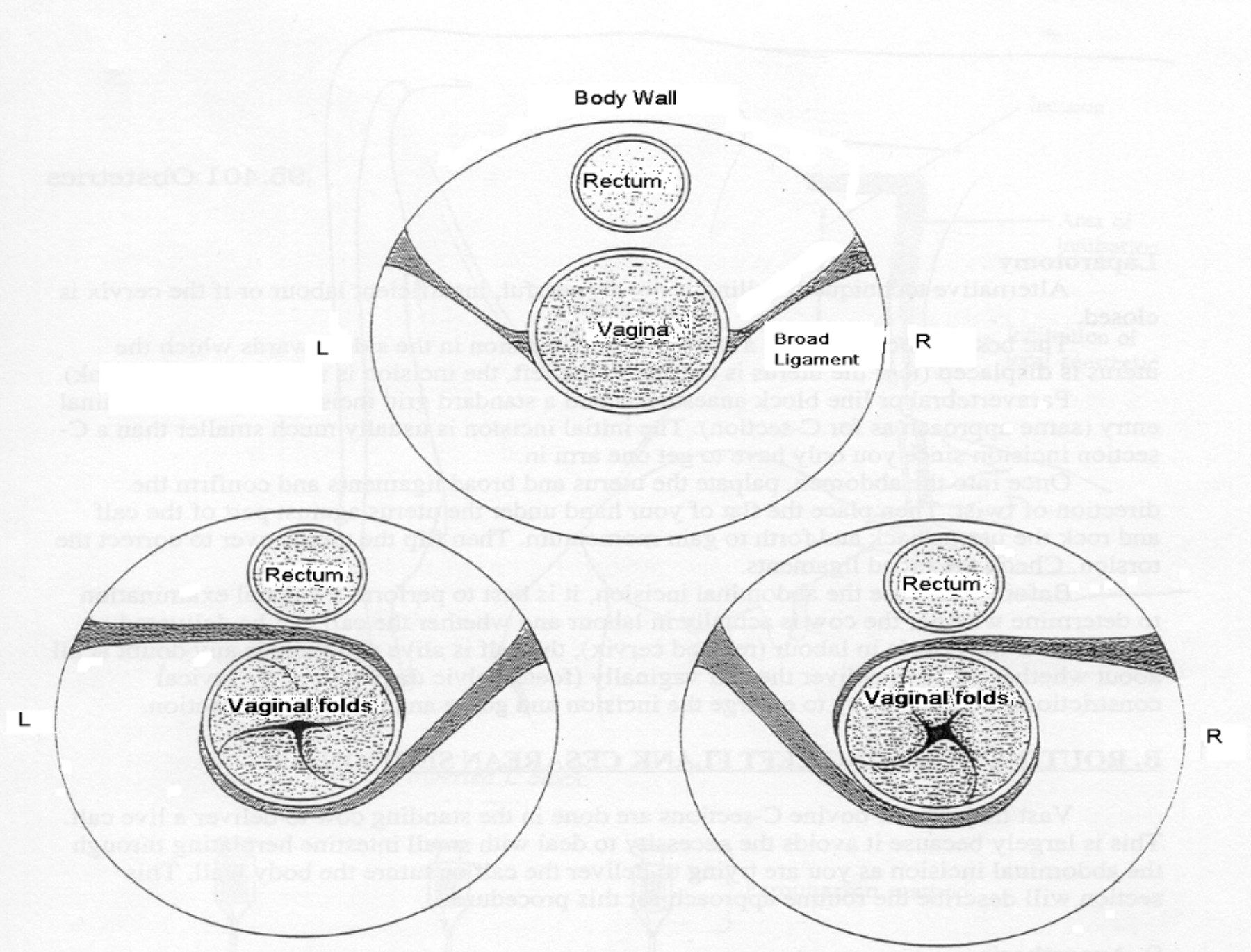 <p><u>Timing:</u> 90% at parturition = Late 1st stage of labour</p><ul><li><p>Does NOT occur in <em>Bos indicus</em> → Different broad ligament anatomy</p></li></ul><p><u>Twist:</u> 90 - 360˚ and 75% anticlockwise (observe from behind cow)</p><p><u>Diagnosis:</u></p><ol><li><p><strong>History</strong> = Failure for delivery to progress beyond 1st stage of labour (farmer may report no cervical dilation)</p></li><li><p>± Deviated angle of vulva</p></li><li><p><strong>Vaginal palpation</strong> = Narrowed and twisted vaginal and cervical lumen</p><ul><li><p><u>DDx:</u> Incomplete cervical dilation</p></li></ul></li><li><p><strong>Rectal palpation</strong> = Broad ligaments spiralling over top of uterine body → Confirms diagnosis ± Oversized calf</p></li></ol><p>→ Determine which direct the twist is occurring via vaginal and/or rectal palpation</p><ul><li><p>Twist occurs in the SAME direction as the curve across the top of the vagina</p></li><li><p>Hand swept to right → Clockwise rotation</p></li><li><p>Hand swept to left → Anti-clockwise rotation</p></li></ul><p><u>Treatments:</u></p><ol><li><p>Create momentum</p></li><li><p>GYNstick/Torsion bar</p></li><li><p>Rolling cow</p></li><li><p>C-section</p></li></ol><p></p>
