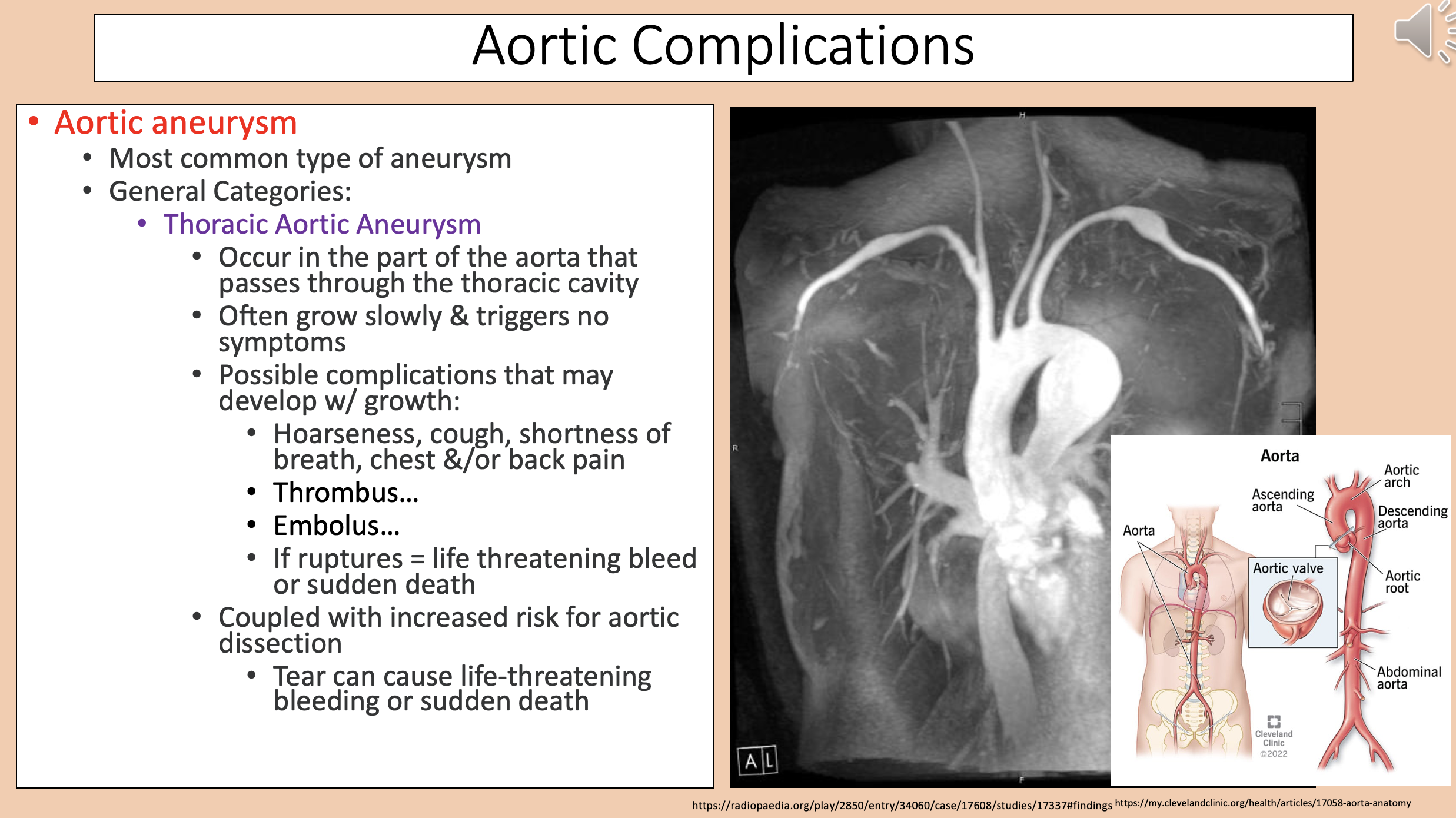 <p><span style="color: rgb(255, 0, 0);">aortic aneurysm</span></p>