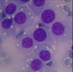 <p>What tumor cell type?</p>