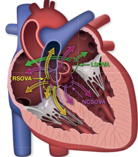 <ol><li><p><strong>LSOVA</strong></p><ul><li><p>may rupture into LA or RA</p></li></ul></li><li><p><strong>NCSOVA</strong></p><ul><li><p>may rupture into LA, RA, LV, or ventricular septum</p></li></ul></li><li><p><strong>RSOVA (most common)</strong></p><ul><li><p>may rupture into LV, RA, RV (across septum), pericardium, adjacent main pulmonary artery</p></li><li><p>can cause most problems: obstruction, dissection, compression, acute MI, heart block, tamponade</p></li></ul></li><li><p><strong>Overall: more blood is being moved back into the heart instead of being pumped out</strong></p></li></ol><p></p>
