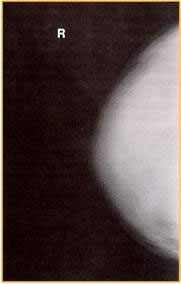 <p>the dense breast consists of primarily connective tissue with very little adipose tissue </p><p>minimal tissue differentiation between the two types of tissue</p>