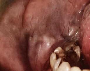 <p>how would you describe this lesion?</p>