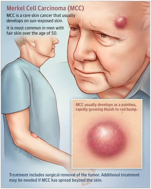 <p>merkel cell carcinoma</p>