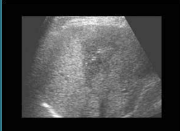 <p>what does this image show about the liver parenchyma</p>
