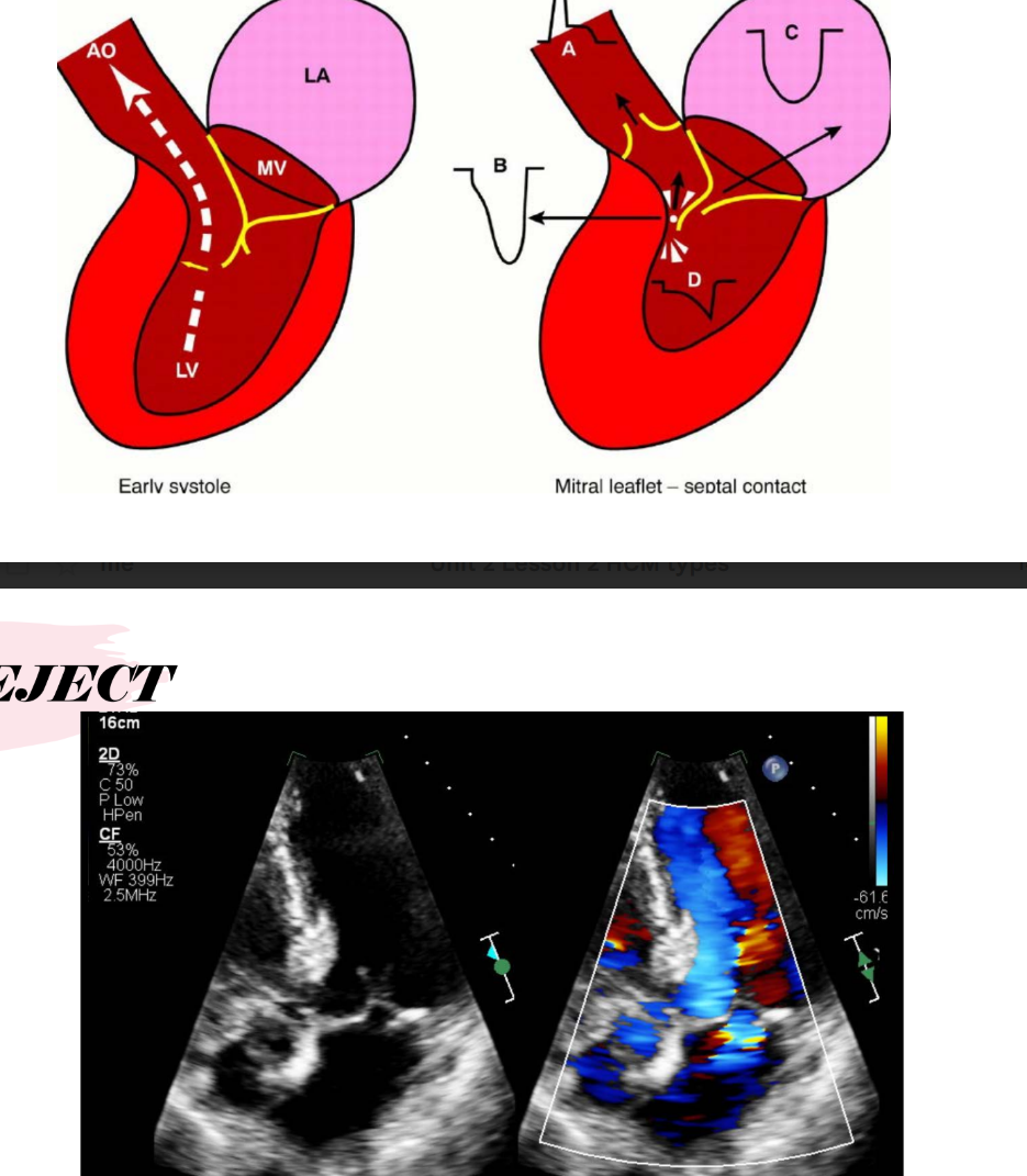 <p>As the mitral valve apparatus or leaflet is pulled toward the LVOT, a gap forms between the anterior and posterior mitral leaflets during systole, causing <strong>mitral regurgitation</strong>.</p>