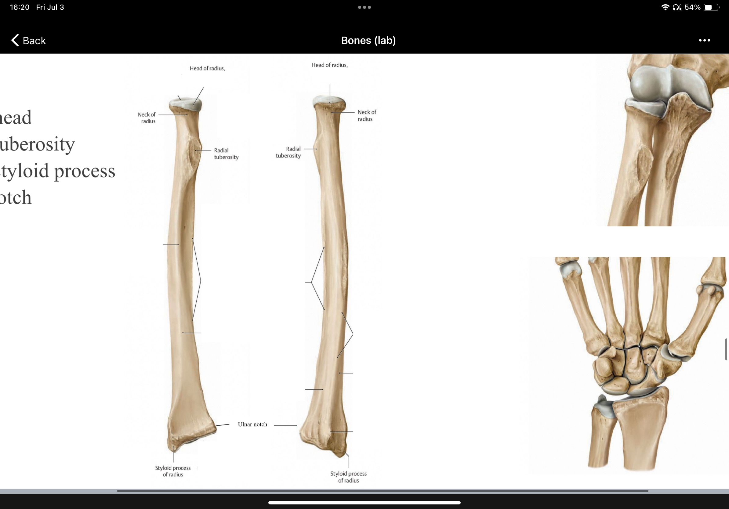 <p>bone is radius </p>