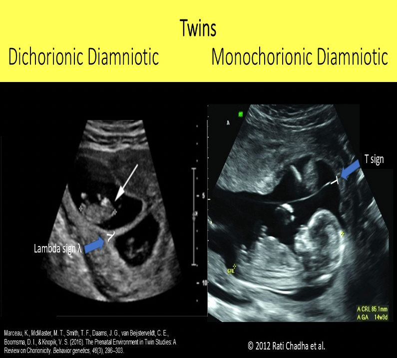 <p>B. dichorionic diamniotic twins, monochorionic diamniotic twins</p><p>The lambda sign indicates dichorionic diamniotic twins. The thick membrane has a triangle of placental tissue at the base of the membrane. The T sign indicates monochorionic diamniotic twins. The membrane attaches to the uterine wall without placental tissue at the base.</p>