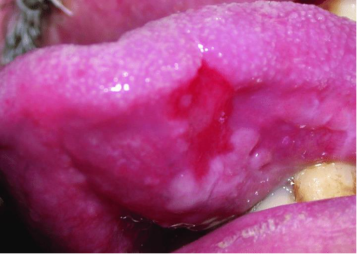 <p>CASE: A previously white oral plaque develops scattered red areas. The red regions appear thin and nonkeratinized compared with the white portions. What is the clinical diagnosis, and why are the red areas concerning?</p>