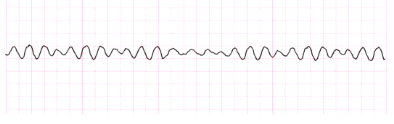 <ul><li><p class="Paragraph SCXW147863853 BCX8" style="text-align: left;"><span style="line-height: 20.85px;">Cause: Acute MI, CAD, cardiomyopathy, VF may occur during cardiac pacing or cardiac catheterization, VF may occur with coronary reperfusion after fibrinolytic therapy, Electrical shock, Hyperkalemia, Hypoxia, Acidosis, Drug toxicity </span></p></li></ul><ul><li><p class="Paragraph SCXW147863853 BCX8" style="text-align: left;"><span style="line-height: 20.85px;">Tx: Immediate initiation of CPR and advanced cardiac life support (ACLS) measures with the use of defibrillation and drug therapy </span></p></li></ul><p></p>