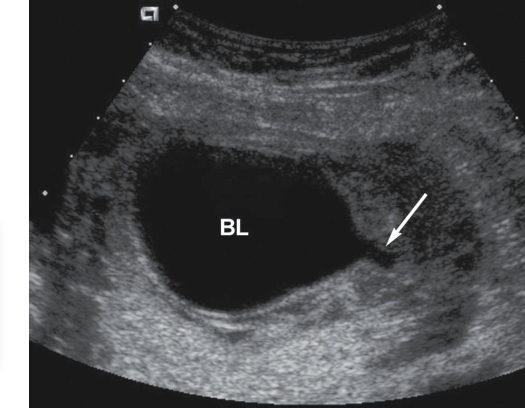 <p>“Keyhole” sign (dilated bladder and urethra)</p><p>Bilateral hydroureter</p><p>Bilateral hydronephrosis</p><p>Oligohydramnios</p><p>Thickened bladder wall</p>