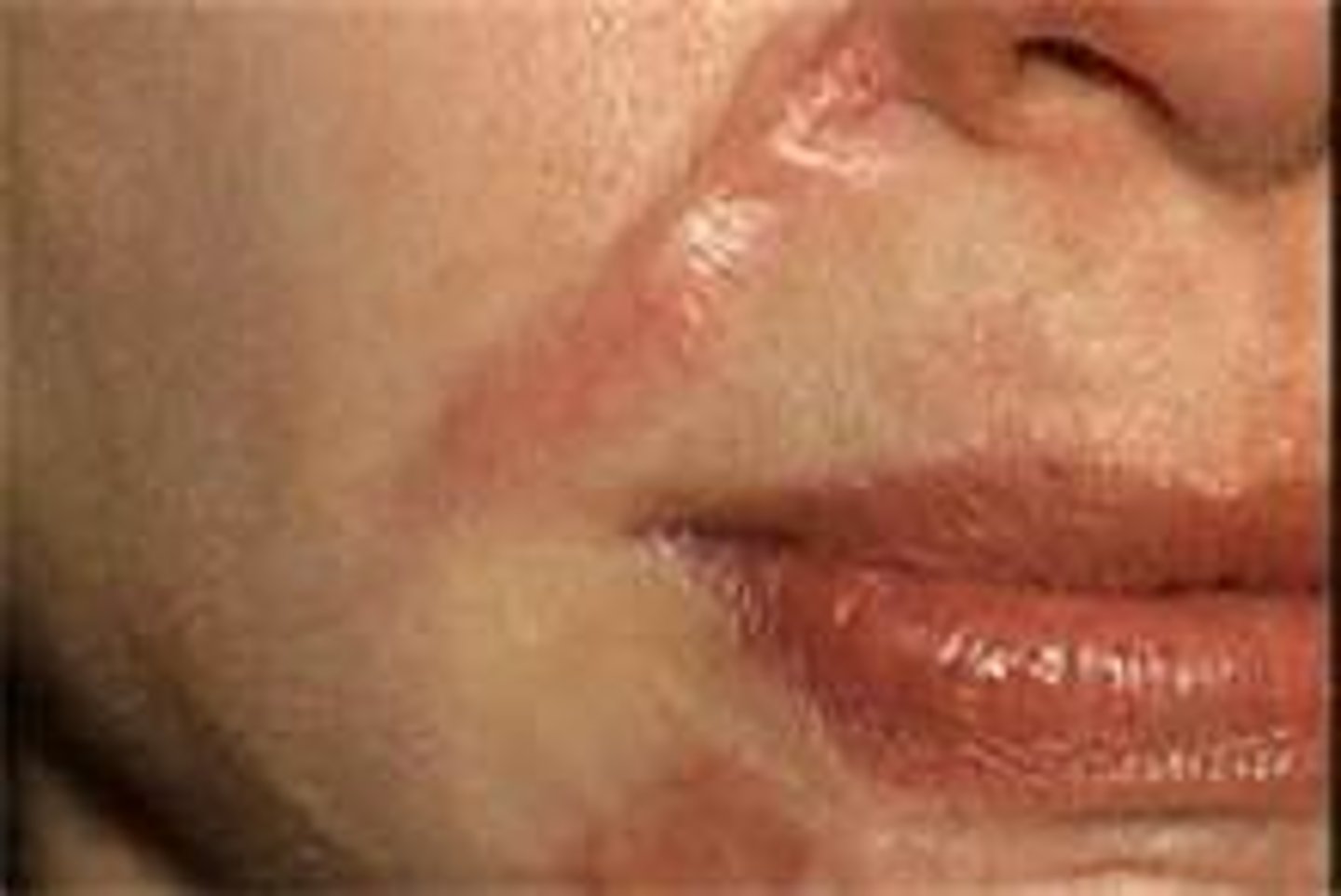 <p>Slightly raised or depressed area of the skin that forms as a result of the healing process related to an injury or lesion.</p>