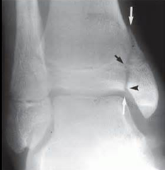 <p>define a salter harris II fracture</p>