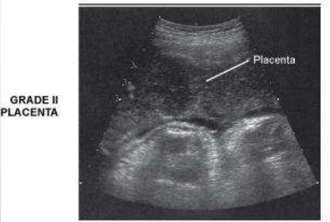 <p>Chorionic plate exhibits mild/medium sized indentations; basal plate contains few small bright linear densities; contains scattered “comma-like” densities (calcifications); normal at any time after 36 weeks of development</p>