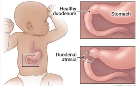 <ul><li><p>constricted duodenum located distal to ampulla of Vater</p><ul><li><p>dilation of duodenum due to stenosis/atresia</p></li><li><p>amniotic fluid enters stomach and upper duodenum (dilation of both)</p></li></ul></li><li><p><span style="color: red;">MC bowel obstruction in fetus</span></p></li><li><p>unknown cause</p></li><li><p><span style="color: red;">associated with T21</span> and cardiac anomalies</p></li><li><p>prognosis: excellent (if isolated)</p></li></ul><p></p>