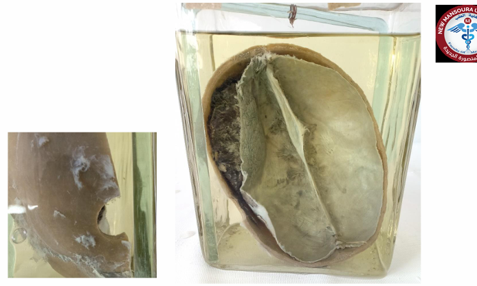 <p>Questions</p><ol><li><p>What is the specimen being examined?</p></li><li><p>What are the type, specific descriptive features, and locations of the findings on the skull?</p></li><li><p>What is the vascular origin of the primary pathology?</p></li><li><p>How is the time of death estimated in relation to the surgical procedure?</p></li><li><p>What is the possible cause of death?</p></li><li><p>What is the final diagnosis for this specimen?</p></li></ol><div data-type="horizontalRule"><hr></div><p></p>