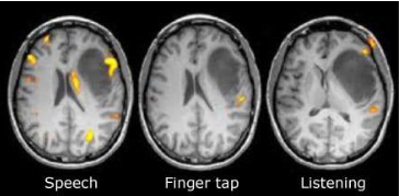 <p>Indirectly measures neural activity, assessing changes in blood flow, volume and local rate of metabolism of oxygen. </p><p>Use: Perform an activity (wiggling tongue) which will cause a notable increase in metabolic activity in the areas of the brain responsible</p><p>Used in PT studies, pain science and neuroplasticity</p>
