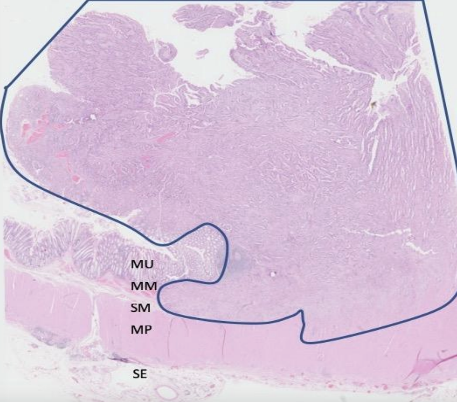 <ul><li><p>The malignant cells have invaded through the muscularis mucosae and into the underlying thick muscle band (known as the muscularis propria). </p></li><li><p>Islands of cells form ragged glandular structures, growing in between the muscle fibres.</p></li><li><p>Cell show: pleomorphism (cells have very variable appearances).; increased nuclear: cytoplasmic ratio. ; less mucin. ; frequent mitotic figures. ; frequent apoptotic bodies.</p></li><li><p>The stroma they invade into becomes fibrotic (desmoplastic).</p></li><li><p>malignant cells may then spread (metastasize) to other sites/ organs: via the blood ; via lymphatics and ; across the peritoneal cavity (transcoelomic spread), if the carcinoma invades through the muscularis propria. </p></li></ul><p></p>