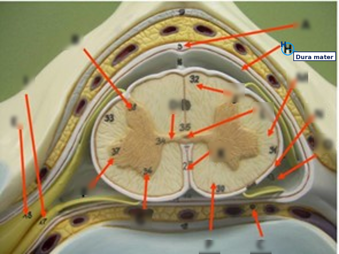 <p>Dura mater (the thick, tough outermost meningeal layer)</p>