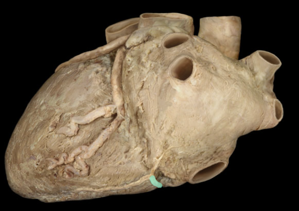 <p>Right coronary artery</p>