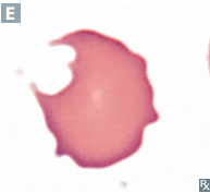 <p>G6PD deficiency</p>