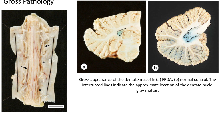 <p>-reduced transverse diameter of the thoracic spinal cord</p><p>-reduced dendate nuclei in cerebellum</p>