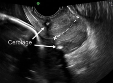<ul><li><p>post-cerclage procedure; imaged transvaginally</p></li><li><p>cerclage stitches are <span style="color: yellow;">echogenic with posterior shadowing</span></p></li><li><p>serial scans may be done to ensure cerclage remains secure and cervix is closed</p></li></ul><p></p>