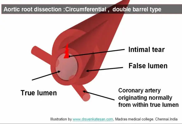 <p>Answer: A tear in the tunica intima that allows blood to track into a false lumen within the tunica media.</p><p>Extra Information:</p><ul><li><p>It is a life-threatening vascular emergency.</p></li><li><p>The false lumen can interfere with normal blood flow to vital organs.</p></li></ul><p></p>